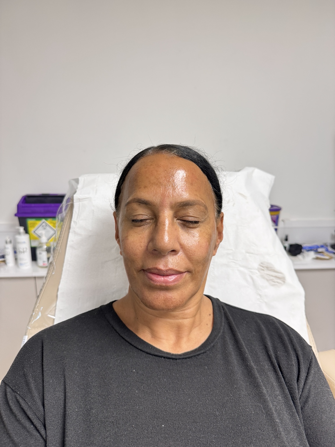 Client's after photograph following a dermaplaning, chemical peel and microneedling facial