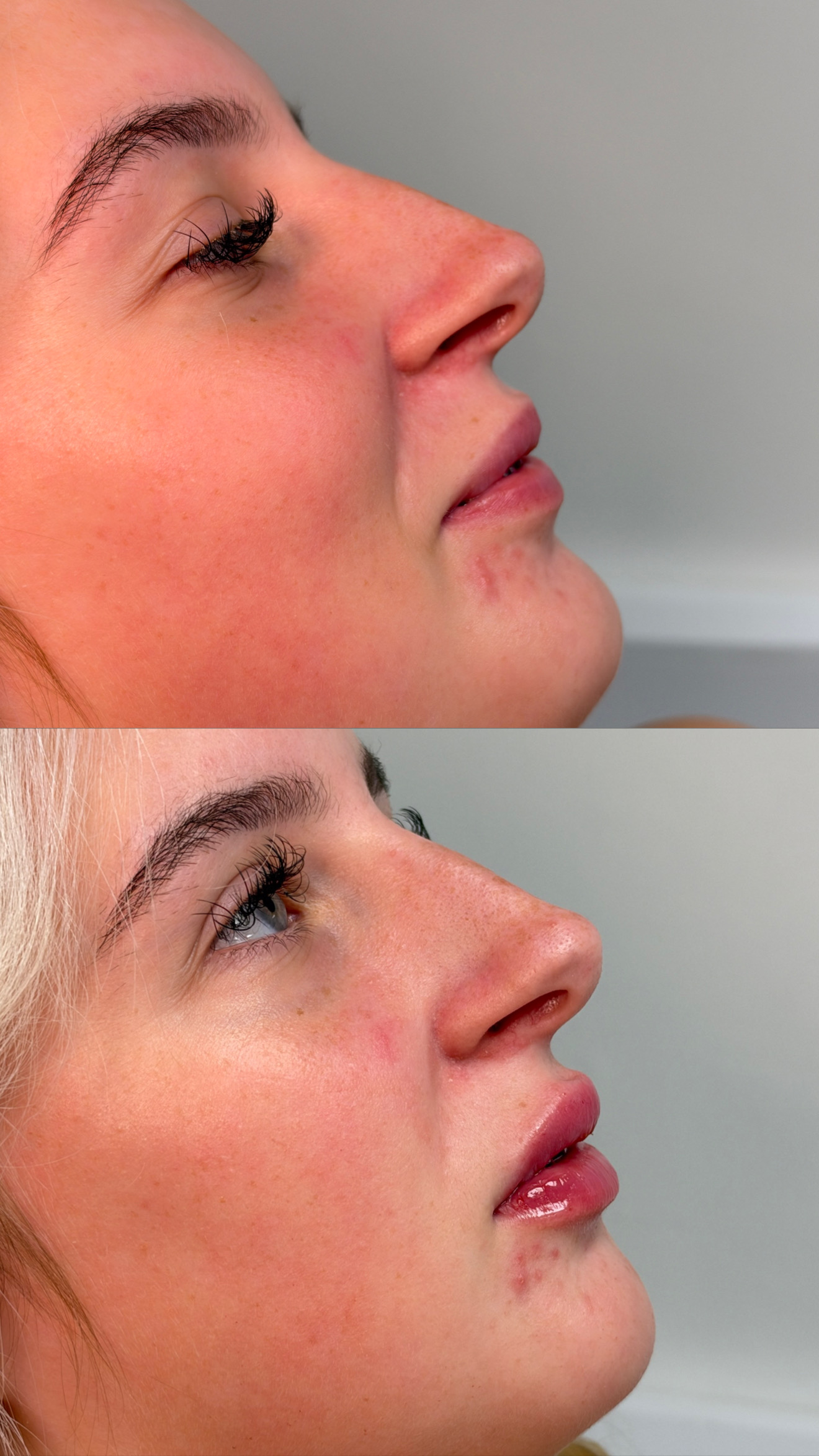 Side-view comparison supplied for a 0.5ml classic lip filler top-up