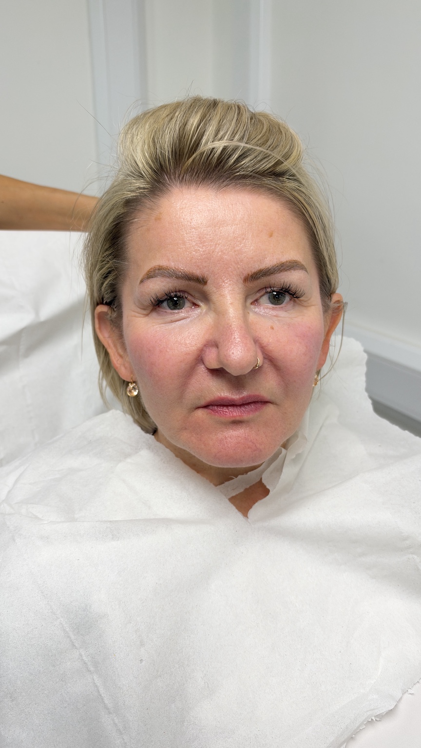 Before nasolabial fold treatment, showing the nose-to-mouth lines